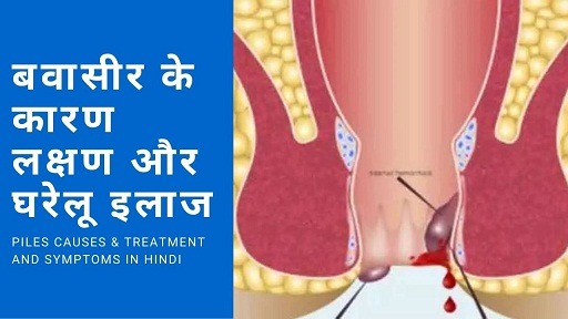 बवासीर के कारण लक्षण और घरेलू इलाज | Piles Causes & Treatment And Symptoms in Hindi